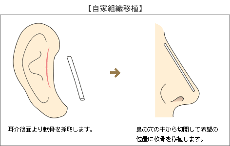 自家組織移植（軟骨・筋膜）とは