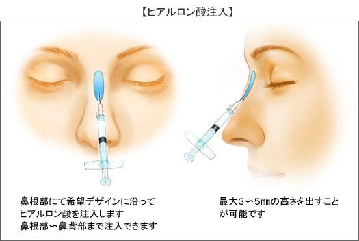 Filler（皮膚充填剤）注入とは