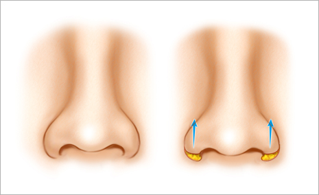 鼻翼縮小・挙上術とは