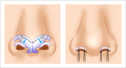 鼻孔縁下降術とは